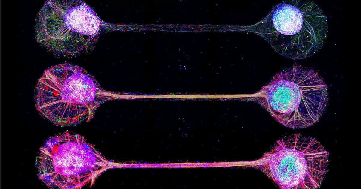 Dementia breakthrough as brain cells connected – possibly sparking new treatment Dementia breakthrough as brain cells connected - possibly sparking new treatment