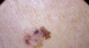 Skin Cancer Breakthroughs, Prevention, and Treatment Advances During the Past Year Skin Cancer Breakthroughs, Prevention, and Treatment Advances During the Past Year