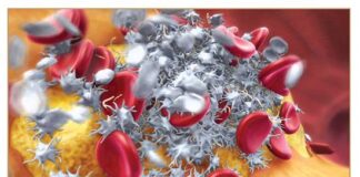 Acute Coronary Syndrome Market: Exploring Treatment Advances, Acute Coronary Syndrome Market