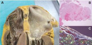 Cardiac Amyloidosis Market Advancing Treatment: Cardiac Amyloidosis Market