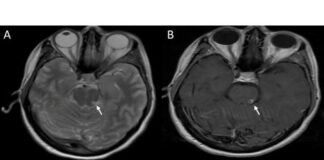 Clinically Isolated Syndrome (CIS) Treatment Market Breakthrough Advances | Philips N.V., GENERAL ELECTRIC COMPANY Clinically Isolated Syndrome (CIS) Treatment Market Breakthrough Advances | Philips N.V., GENERAL ELECTRIC COMPANY