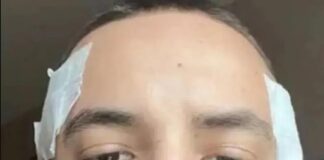 Disturbing wave of suicides after Turkish surgery: Calls grow for mental health checks before cut-price ops – as victims of botched procedures take their own lives Mathieu Vigier Latour after his botched hair transplant in Istanbul