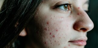 Experts link sleeplessness, anxiety, depression to Eczema Experts link sleeplessness, anxiety, depression to Eczema