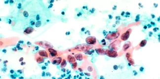 New Cervical Cancer Treatment Reduces Death Risk by 40% – Breakthrough Study New Cervical Cancer Treatment Reduces Death Risk by 40% – Breakthrough Study