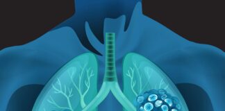 Sunvozertinib Receives Breakthrough Therapy Designation for Treatment-Naive EGFR Exon 20+ NSCLC in China Sunvozertinib Receives Breakthrough Therapy Designation for Treatment-Naive EGFR Exon 20+ NSCLC in China