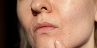 Facial dandruff getting you down? Here's how to optimise nutrition and skincare for a flake-free face Facial dandruff getting you down? Here's how to optimise nutrition and skincare for a flake-free face