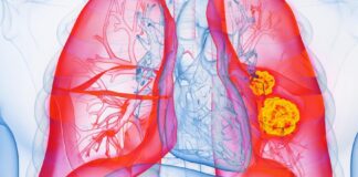 The Latest Advances in Lung Cancer Treatment The Latest Advances in Lung Cancer Treatment