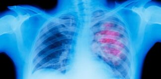 Wellness Wednesday: Lung cancer awareness | Health Wellness Wednesday: Lung cancer awareness | Health