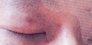 The Surprising Link Between Stress and Eczema Flare-Ups The Surprising Link Between Stress and Eczema Flare-Ups