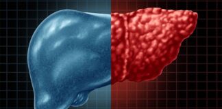 BMI & Nutrition Support Predict Weight Loss in Liver Disease BMI & Nutrition Support Predict Weight Loss in Liver Disease