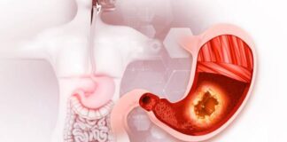 Breakthroughs and Rising Demand Propel Stomach Cancer Stomach Cancer Treatment Market