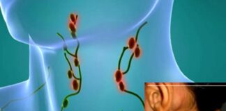 Breakthroughs in Targeted Therapies Propel Hodgkin’s Lymphoma Hodgkin