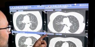 MSK Researchers Present Advances in Lung Cancer Treatment at 2025 ASCO Meeting MSK Researchers Present Advances in Lung Cancer Treatment at 2025 ASCO Meeting