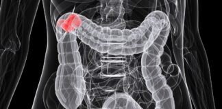 Shapeshifting bowel cancer cells key to treatment breakthrough Shapeshifting bowel cancer cells key to treatment breakthrough