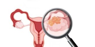 Breakthroughs and Rising Investments Drive Ovarian Cancer Ovarian Cancer Market