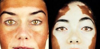 Hypopigmentation Disorder Treatment Market Set to Surge with Hypopigmentation Disorder Treatment Market