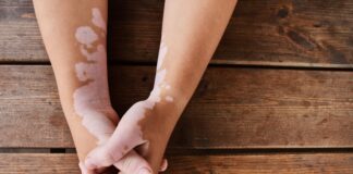 Insights on Mental Health, Nutrition in Pediatric Vitiligo Insights on Mental Health, Nutrition in Pediatric Vitiligo