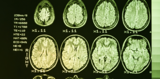 Huntington’s Disease Treatment Breakthrough: What to Know Huntington’s Disease Treatment Breakthrough: What to Know