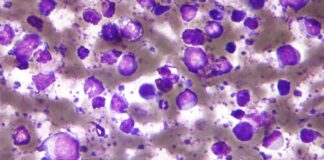 B-Cell Lymphoma: Breakthroughs in Treatment Offer Fresh Hope B-Cell Lymphoma: Breakthroughs in Treatment Offer Fresh Hope