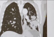 Breakthrough lung cancer treatment | FOX 13 Tampa Bay Breakthrough lung cancer treatment | FOX 13 Tampa Bay