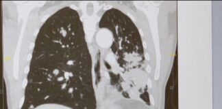 Breakthrough lung cancer treatment | FOX 13 Tampa Bay Breakthrough lung cancer treatment | FOX 13 Tampa Bay