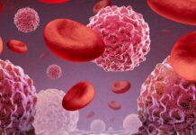 FDA Grants Breakthrough Designation to Sofi-cel for Relapsed/Refractory T-Cell ALL/LBL brain cancer