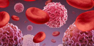 FDA Grants Breakthrough Designation to Sofi-cel for Relapsed/Refractory T-Cell ALL/LBL brain cancer