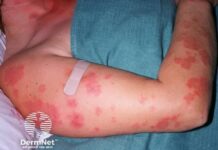 FDA Grants Breakthrough Therapy Designation to Litifilimab for Cutaneous Lupus Erythematosus FDA Grants Breakthrough Therapy Designation to Litifilimab for Cutaneous Lupus Erythematosus