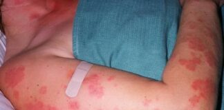 FDA Grants Breakthrough Therapy Designation to Litifilimab for Cutaneous Lupus Erythematosus FDA Grants Breakthrough Therapy Designation to Litifilimab for Cutaneous Lupus Erythematosus