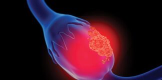 FDA OKs Breakthrough Status for Sofetabart Mipitecan for Some Gynecologic Cancers Image of man.