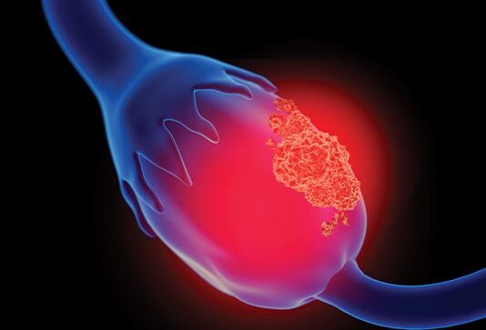 FDA OKs Breakthrough Status for Sofetabart Mipitecan for Some Gynecologic Cancers Image of man.