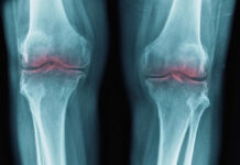 New Breakthrough to Restore Aging Joints Could Help Treat Osteoarthritis : ScienceAlert New Breakthrough to Restore Aging Joints Could Help Treat Osteoarthritis : ScienceAlert