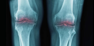 New Breakthrough to Restore Aging Joints Could Help Treat Osteoarthritis : ScienceAlert New Breakthrough to Restore Aging Joints Could Help Treat Osteoarthritis : ScienceAlert