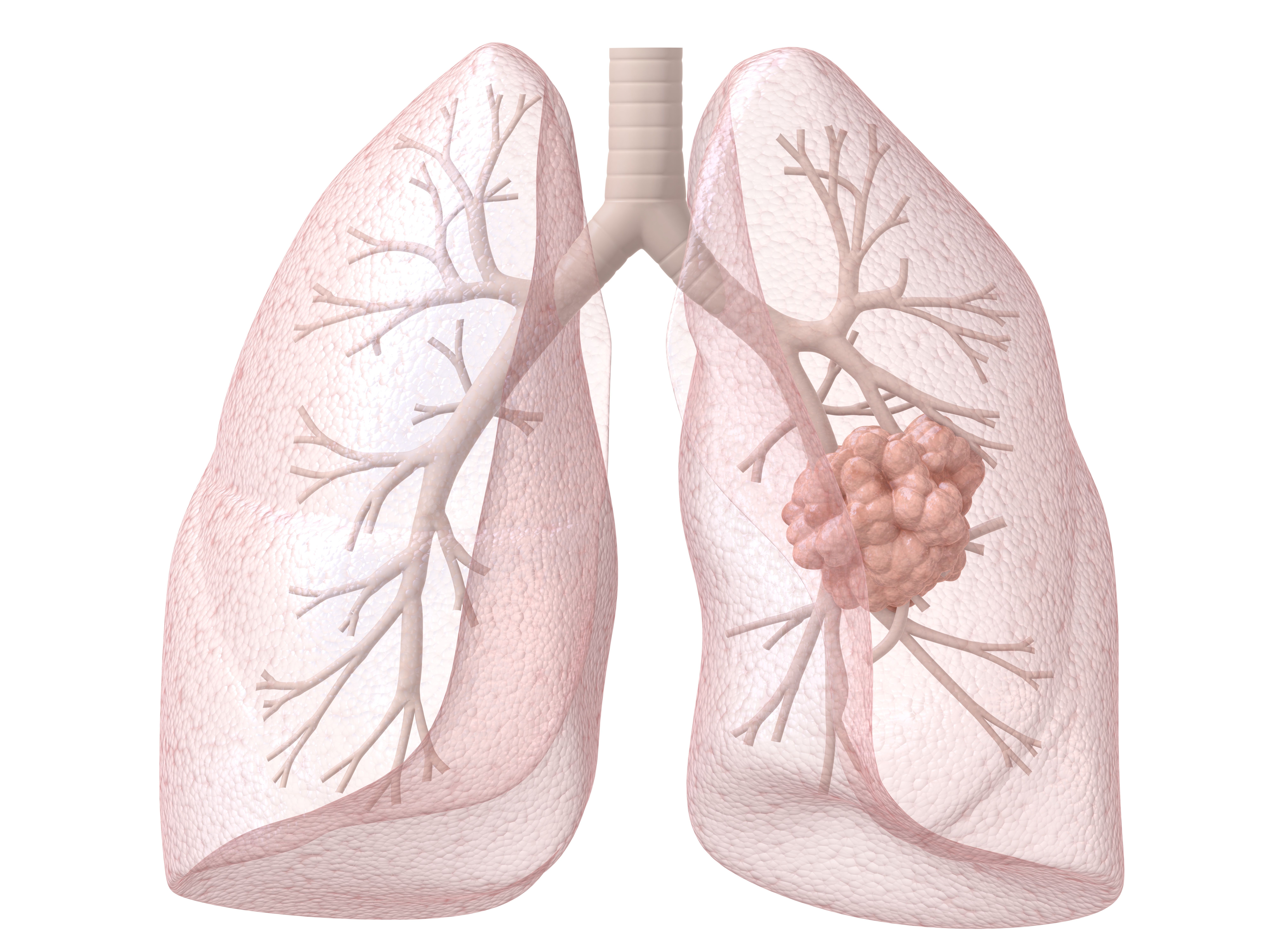 Zoldonrasib Earns FDA Breakthrough Therapy Designation in KRAS G12D+ NSCLC Consistent with FGFR2 inhibition, lirafugratinib was well-tolerated among patients with FGFR2-mutated cholangiocarcinoma in the ReFocus trial.