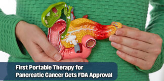 Breakthrough TTFields Technology Gets FDA Approval for Pancreatic Cancer Treatment he U.S. Food and Drug Administration has approved a first-of-its-kind device for the treatment of adult patients with locally advanced pancreatic cancer. Optune Pax, developed by Novocure, is a portable, non-invasive device that delivers alternating electrical fields, known as tumor treating fields (TTFields), to the abdomen. TTFields work by physically disrupting the rapid cell division that is characteristic of cancer cells, while minimizing damage to healthy tissue. Image for illustration purposes
