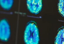 Bridging the Gap: How the University of Utah’s StrokeNet Is Delivering Breakthroughs to the Mountain West | University of Utah Health Bridging the Gap: How the University of Utah's StrokeNet Is Delivering Breakthroughs to the Mountain West | University of Utah Health