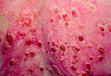 FDA Breakthrough Therapy Designation Granted for Litifilimab for Cutaneous Lupus FDA Breakthrough Therapy Designation Granted for Litifilimab for Cutaneous Lupus