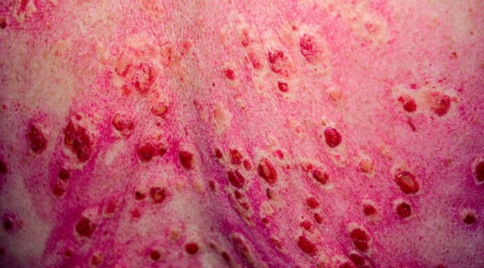 FDA Breakthrough Therapy Designation Granted for Litifilimab for Cutaneous Lupus FDA Breakthrough Therapy Designation Granted for Litifilimab for Cutaneous Lupus