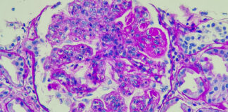 Autoimmune field buoyed by successes with CAR-T treatments Autoimmune field buoyed by successes with CAR-T treatments