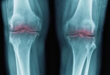 Breakthrough to Restore Aging Joints Could Help Treat Osteoarthritis : ScienceAlert Breakthrough to Restore Aging Joints Could Help Treat Osteoarthritis : ScienceAlert