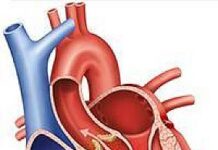 Heart-healthy habits over time linked to a lower risk of aortic stenosis Heart-healthy habits over time linked to a lower risk of aortic stenosis