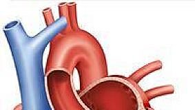 Heart-healthy habits over time linked to a lower risk of aortic stenosis Heart-healthy habits over time linked to a lower risk of aortic stenosis