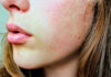 Hydroxychloroquine, Sun Protection & Flare Prevention Tips Close View of Womans Face