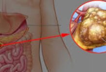 Pancreatic Cancer Breakthrough Gives New Hope: Patients, Treatment, Survival And New Drug Advances Could Change The Future Pancreatic Cancer Breakthrough Gives New Hope: Patients, Treatment, Survival And New Drug Advances Could Change The Future